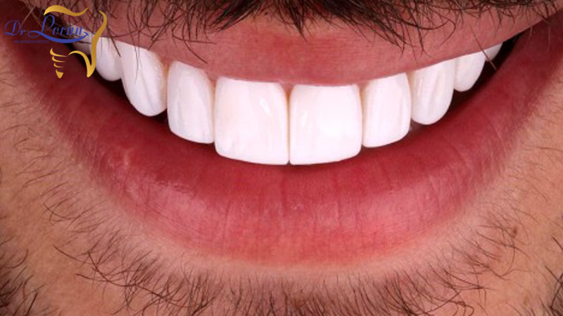 بهترین مرکز پروتز دندان تهران | دکتر ونوس لران