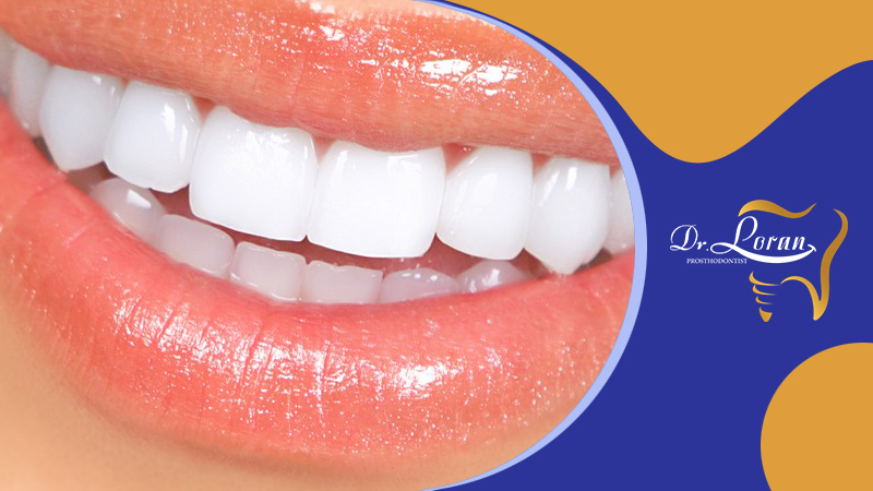 لمینت سرامیکی دندان در بهترین مرکز دندانپزشکی زیبایی زعفرانیه