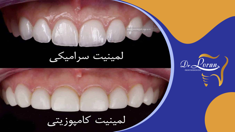 کامپوزیت دندان چیست؟ تفاوت بین کامپوزیت و لمینت
