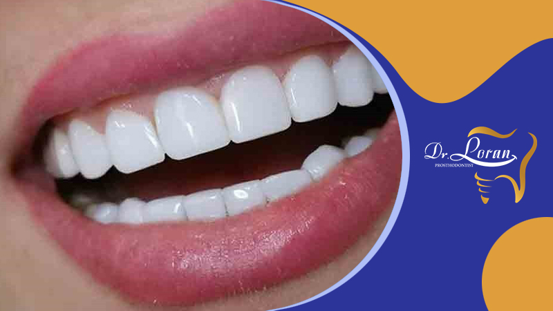 تفاوت بین لمینت دندان و ونیر دندان چیست؟