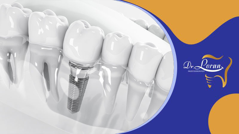 اصول بهداشت دهان و دندان برای افراد با ایمپلنت دندانی