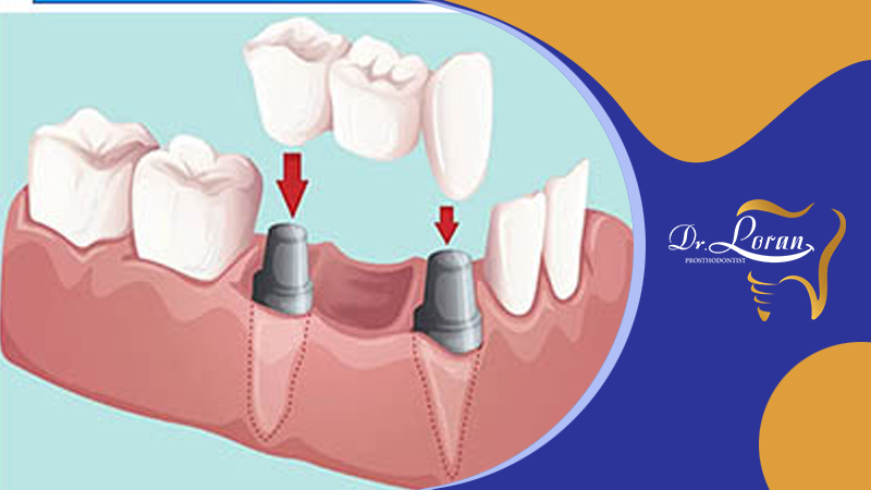 خطرات پروتز دندان چیست؟