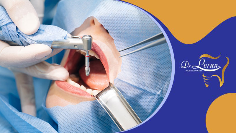 مراحل کاربرد ایمپلنت دندانی: از ارزیابی تا نصب دندان‌های مصنوعی