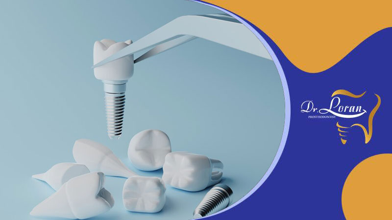 مزایا و معایب ایمپلنت دندانی در مقایسه با روش‌های جایگزینی دندان دیگر