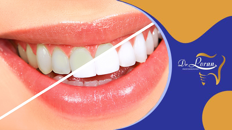 بلیچینگ دندان: روشها و مراحل سفید کردن دندان + مزایا و معایب