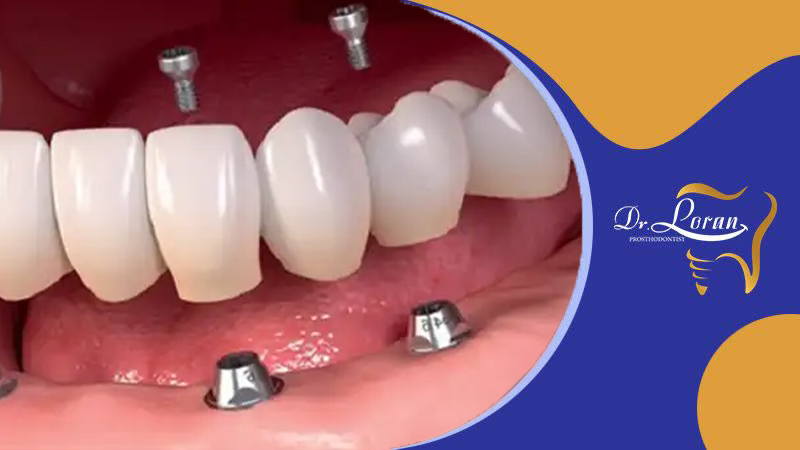 ویژگی های و مزیت های ایمپلنت دندان نسبت به پروتز دندانی (دندان مصنوعی)