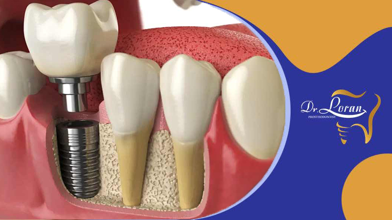 پروتز های دندان: مراحل و مراقبت‌های پس از پروتز های متحرک و ثابت دندان